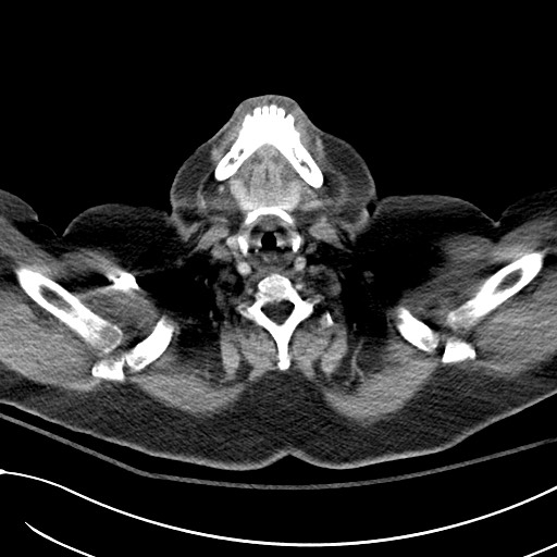 File:Breast carcinoma with pathological hip fracture (Radiopaedia 60314-67974 A 1).jpg