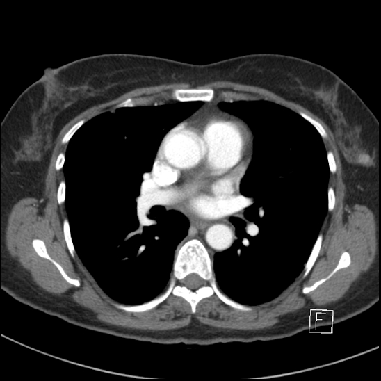File:Breast metastases from renal cell cancer (Radiopaedia 79220-92225 A 46).jpg