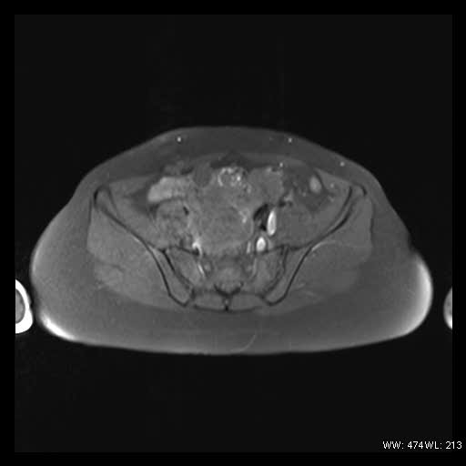 File:Broad ligament fibroid (Radiopaedia 49135-54241 Axial T1 fat sat 12).jpg