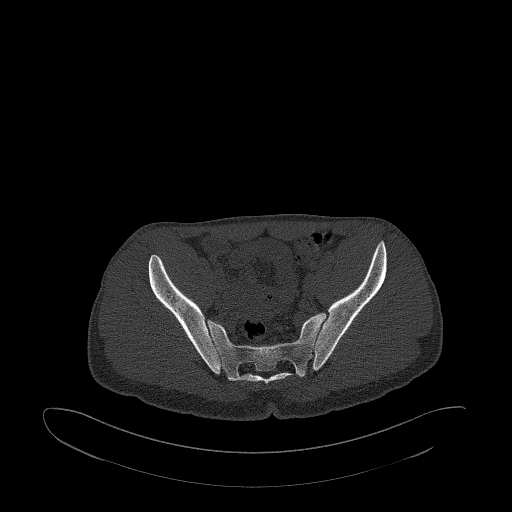 Brodie abscess- femoral neck (Radiopaedia 53862-59966 Axial bone window 74).jpg