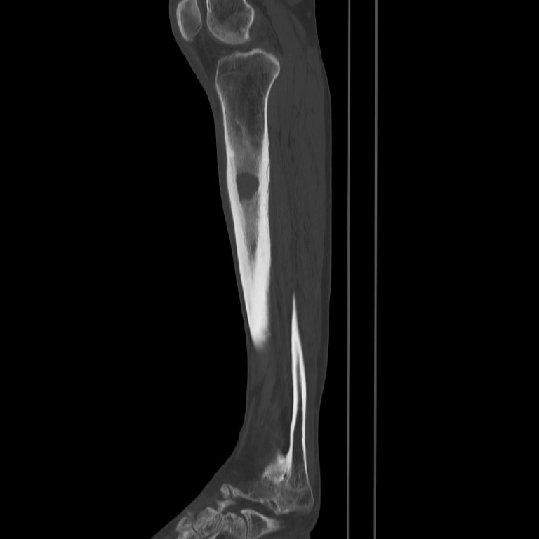 Brodie abscess - tibia (Radiopaedia 66028-75204 Sagittal bone window 42).jpg