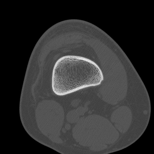 Brodie abscess of the tibia (Radiopaedia 58984-66250 Axial bone window 9).jpg