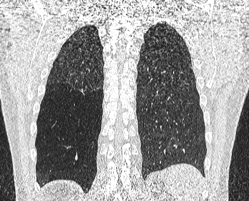 Bronchial atresia (Radiopaedia 58271-65417 Coronal lung window 48).jpg