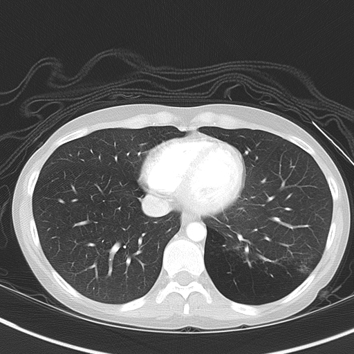 Bronchial atresia (Radiopaedia 73677-84470 Axial lung window 44).jpg