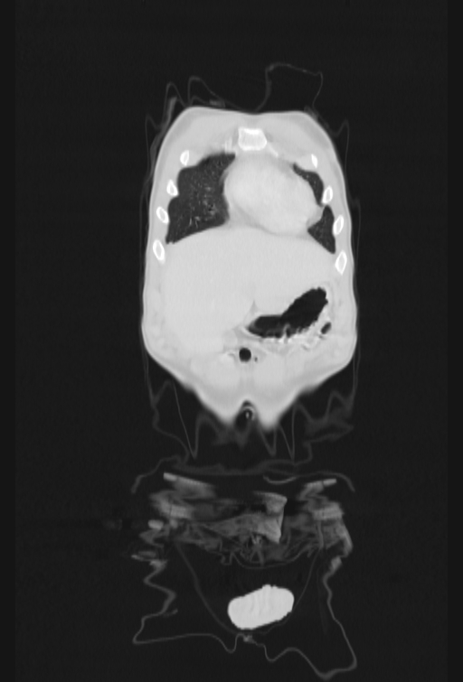 Bronchial carcinoid tumor (Radiopaedia 57187-64090 Coronal lung window 5).jpg