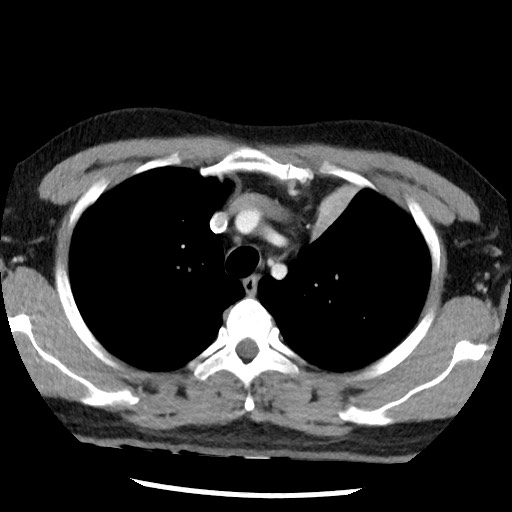 Bronchial carcinoid tumor (Radiopaedia 67377-76764 A 18).jpg