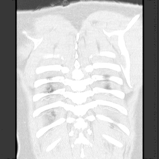 Bronchial carcinoid tumor (Radiopaedia 67377-76764 Coronal lung window 56).jpg
