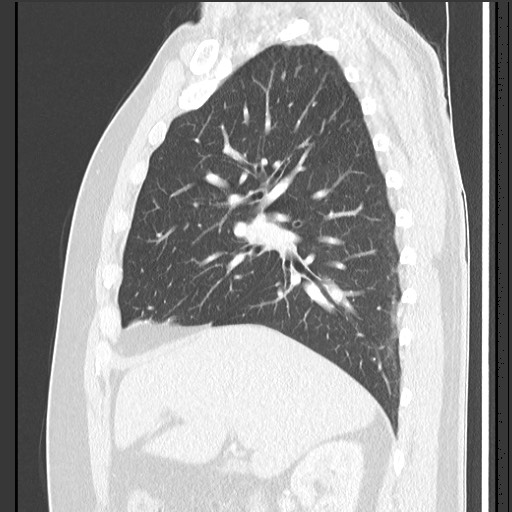 Bronchial carcinoid tumor (Radiopaedia 67377-76764 Sagittal lung window 25).jpg