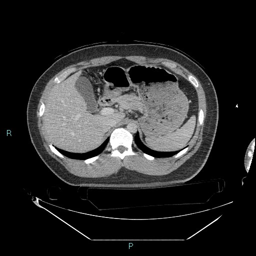 File:Bronchial carcinoid tumor (Radiopaedia 78272-90870 C 119).jpg