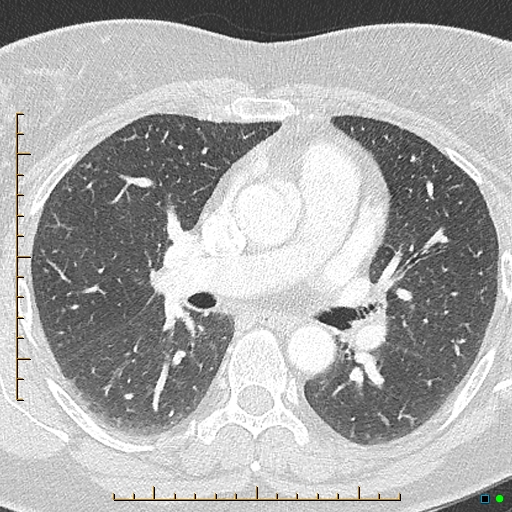 File:Bronchial diverticula (Radiopaedia 79512-92676 Axial lung window 89).jpg