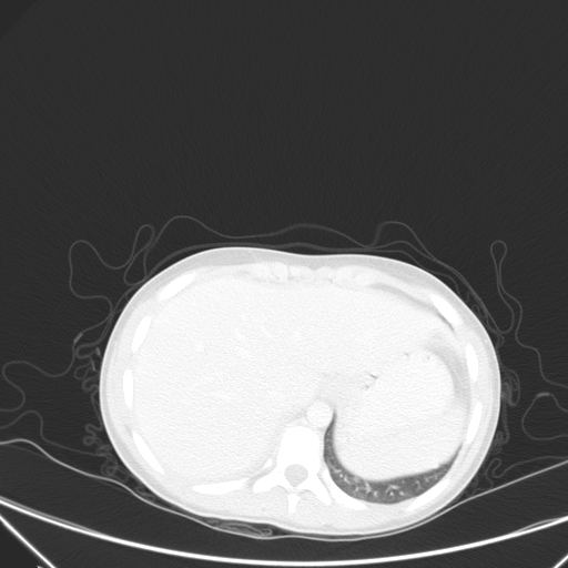Bronchial mucoepidermoid carcinoma (Radiopaedia 57023-63895 Axial lung window 107).jpg