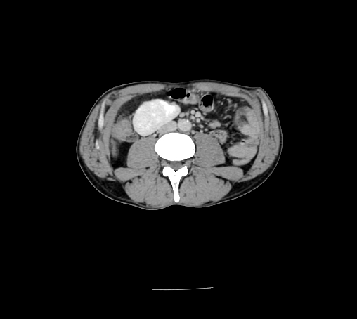 Bronchiectasis in Crohn disease (Radiopaedia 60311-67977 B 93).jpg