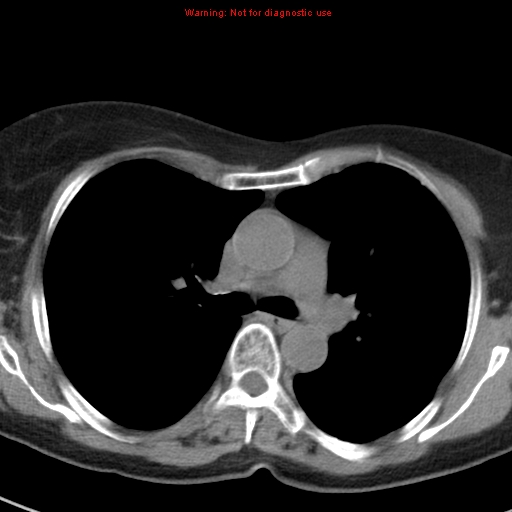 File:Bronchoalveolar carcinoma (BAC) (Radiopaedia 13436-13392 Axial non-contrast 22).jpg