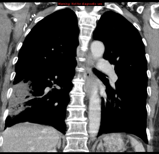 Bronchoalveolar carcinoma (BAC) (Radiopaedia 13436-13392 E 35).jpg