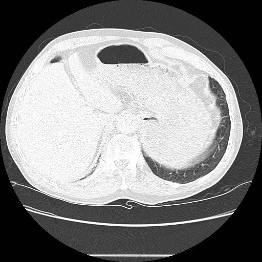 Bronchocele (Radiopaedia 17097-16795 Axial lung window 107).jpg