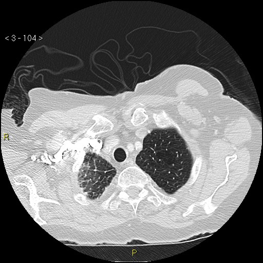 Bronchogenic carcinoma as an incidental finding (Radiopaedia 16453-16130 Axial lung window 104).jpg