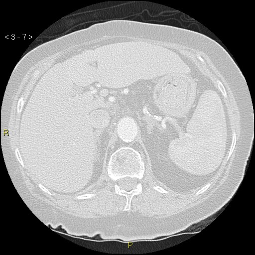 Bronchogenic carcinoma as an incidental finding (Radiopaedia 16453-16130 Axial lung window 7).jpg