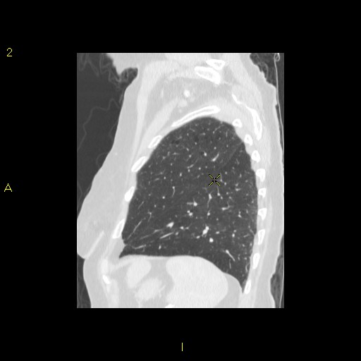 File:Bronchogenic carcinoma as an incidental finding (Radiopaedia 16453-16130 Sagittal lung window 12).jpg