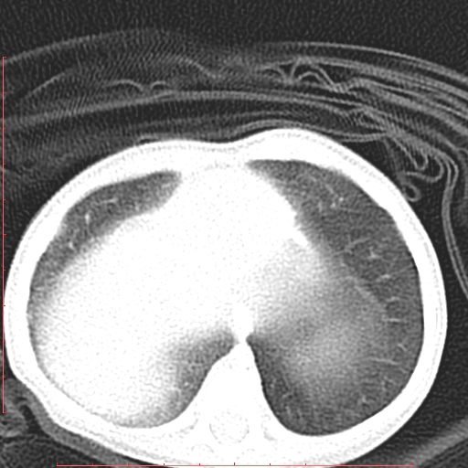 Bronchogenic cyst (Radiopaedia 78599-91409 Axial lung window 123).jpg
