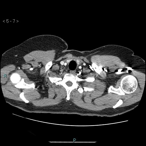Bronchogenic cyst - posterior mediastinal (Radiopaedia 43885-47364 A 4).jpg