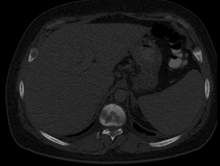 File:Brown tumors compressing the spinal cord (Radiopaedia 68442-77988 Axial bone window 71).jpg