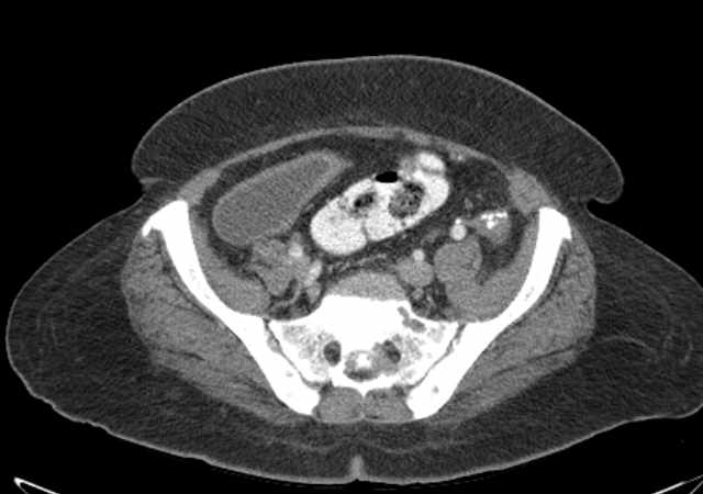 File:Brown tumors compressing the spinal cord (Radiopaedia 68442-77988 E 95).jpg