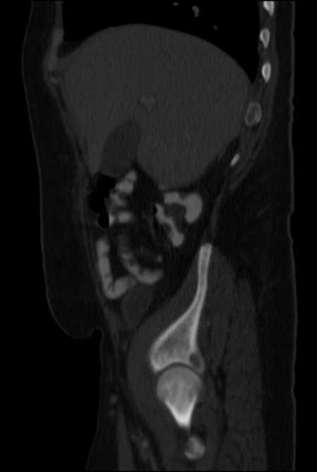 Brown tumors compressing the spinal cord (Radiopaedia 68442-77988 H 15).jpg