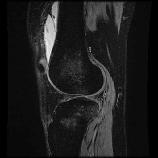 Bucket handle meniscus tear (Radiopaedia 56916-63751 H 23).jpg