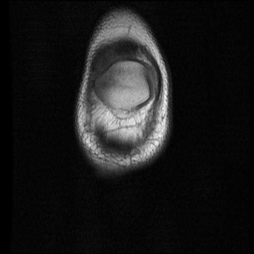 File:Bucket handle tear - lateral meniscus (Radiopaedia 72124-82634 Coronal T1 1).jpg
