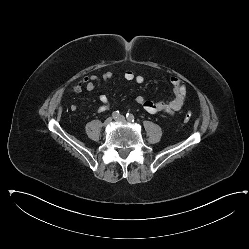 Buried bumper syndrome - gastrostomy tube (Radiopaedia 63843-72577 Axial Inject 80).jpg