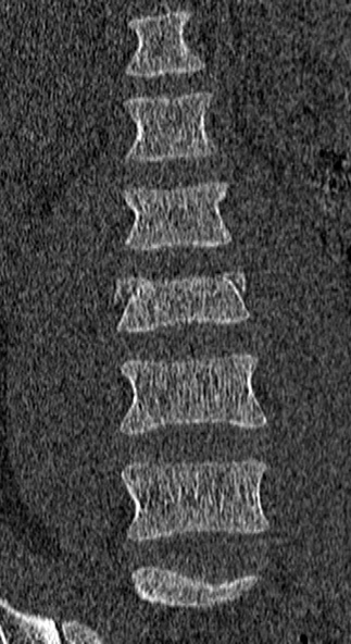 File:Burst fracture (Radiopaedia 53373-59357 Coronal bone window 18).jpg