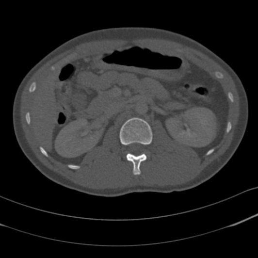 Burst fracture with cauda equina syndrome (Radiopaedia 25701-25867 Axial bone window 12).jpg
