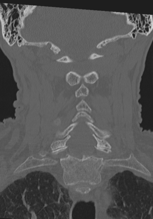 C2 fracture with vertebral artery dissection (Radiopaedia 37378-39199 Coronal bone window 29).png
