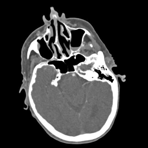 File:C2 fracture with vertebral artery dissection (Radiopaedia 37378-39200 A 220).png