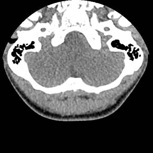 File:C5 facet fracture (Radiopaedia 58374-65499 Axial non-contrast 1).jpg