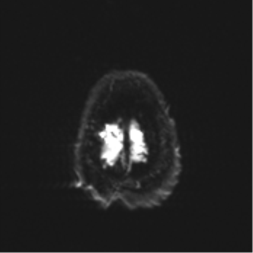 CNS aspergillosis (Radiopaedia 74204-85058 Axial DWI 39).png