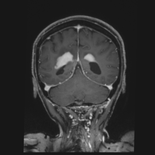 CNS lymphoma with steroid response (Radiopaedia 37980-39921 Coronal T1 C+ 35).png