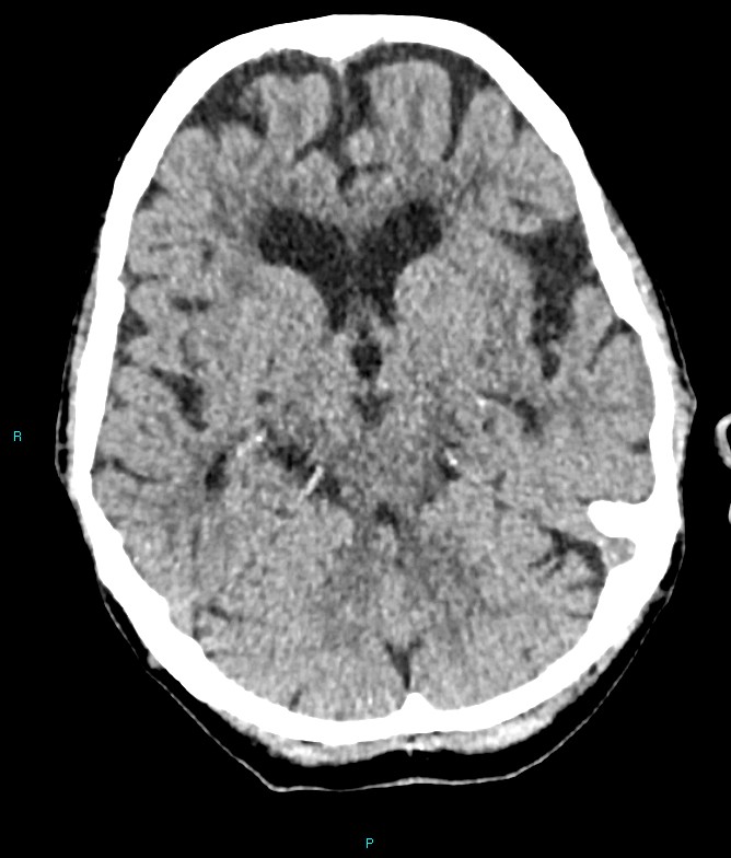 Calcified cerebral emboli from left ventricular thrombus (Radiopaedia 84420-99758 Axial non-contrast 60).jpg