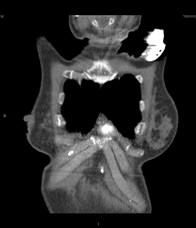 Calcified cerebral emboli from left ventricular thrombus (Radiopaedia 84420-99760 Coronal C+ CTPA 65).jpg