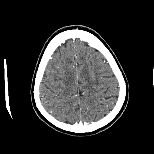Calcified cerebral hydatid cyst (Radiopaedia 65603-74717 Axial with contrast 65).jpg