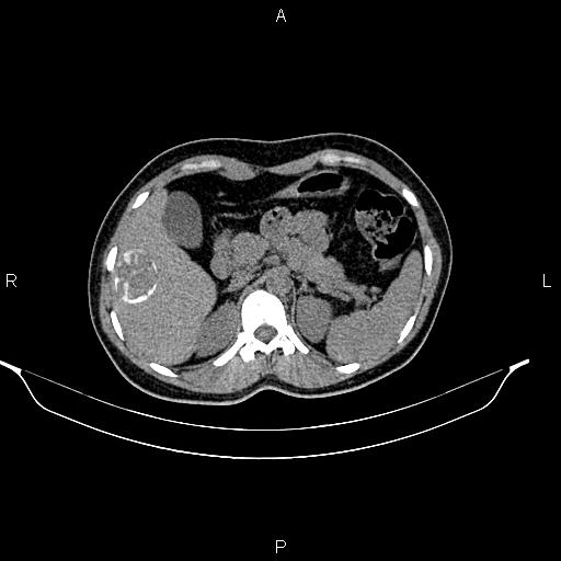 File:Calcified hepatic hydatid cyst (Radiopaedia 84672-100095 Axial non-contrast 31).jpg