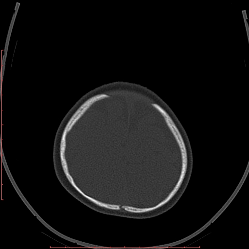 Calcified middle cerebral artery embolism (Radiopaedia 78949-91860 Axial bone window 64).jpg