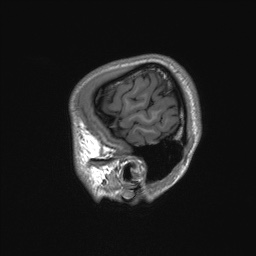 Callosal dysgenesis with interhemispheric cyst (Radiopaedia 53355-59335 Sagittal T1 19).jpg