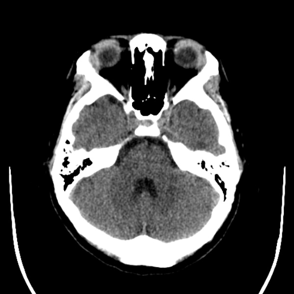 Calvarial osteoma (Radiopaedia 36520-38079 Axial non-contrast 16).jpg