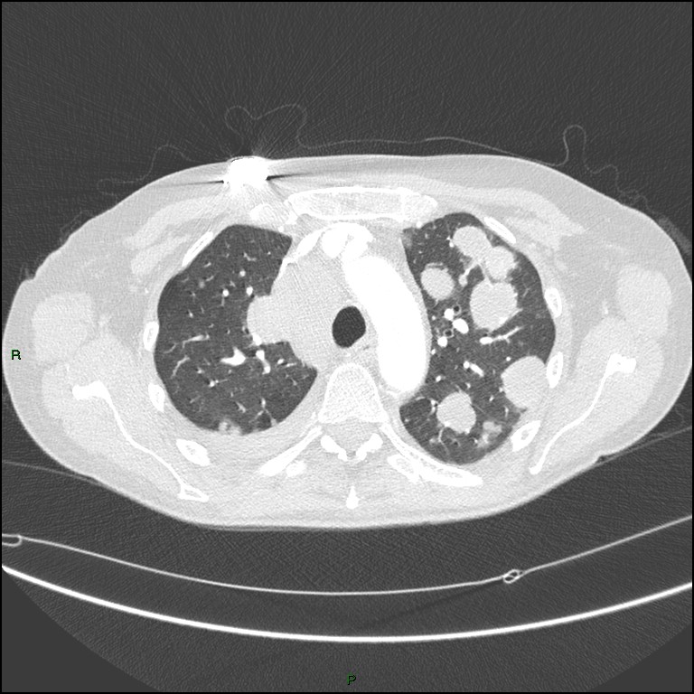 Cannonball metastases (Radiopaedia 82110-96150 Axial lung window 62).jpg