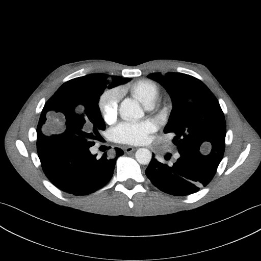 Cannonball metastases - testicular choriocarcinoma (Radiopaedia 84510-99891 B 64).jpg