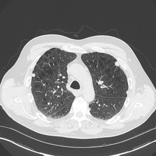 Caplan syndrome (Radiopaedia 56667-63530 Axial lung window 72).jpg