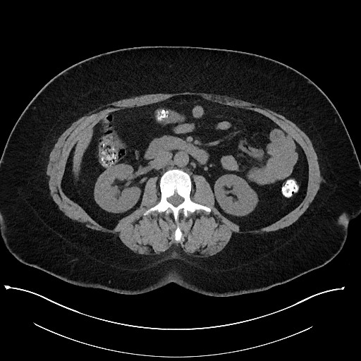 Carcinoid tumor - terminal ileum (Radiopaedia 60931-68740 Axial non-contrast 51).jpg