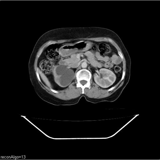 Carcinoma cervix- recurrence (Radiopaedia 34702-36137 B 19).jpg
