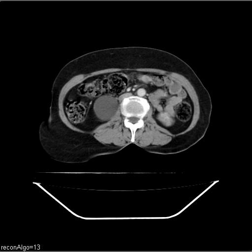 File:Carcinoma cervix- recurrence (Radiopaedia 34702-36137 B 26).jpg